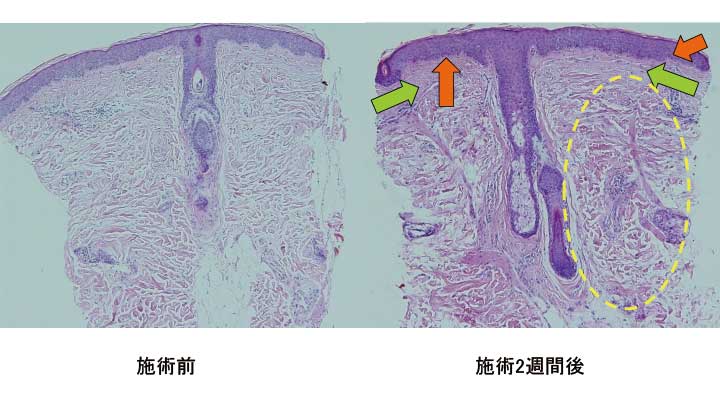 ヒーライト照射後のコラーゲン増産によるシワやタルミ改善