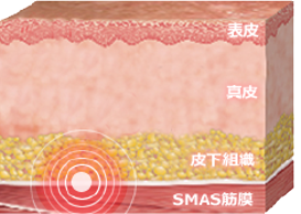 SMAS筋膜にHIFUを照射できるのは医療機関のみ