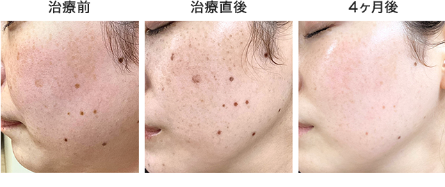 フォトシルクプラスしみ・Qスイッチヤグほくろ治療の症例写真
