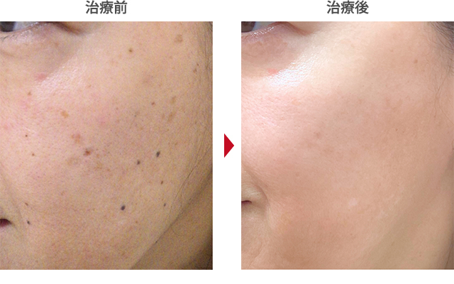 フォトシルクプラスしみ治療の症例写真