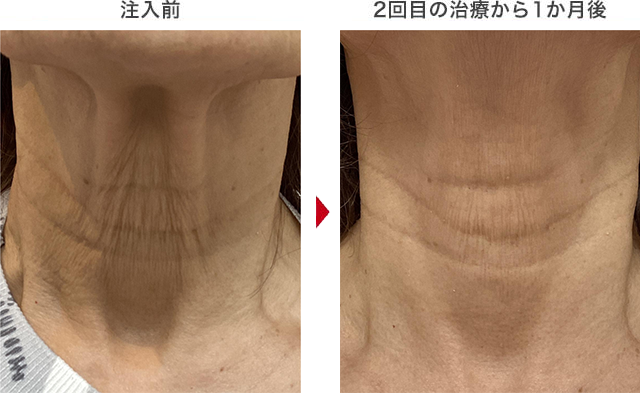 プロファイロの症例写真