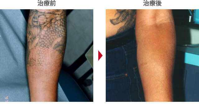 タトゥー除去症例写真