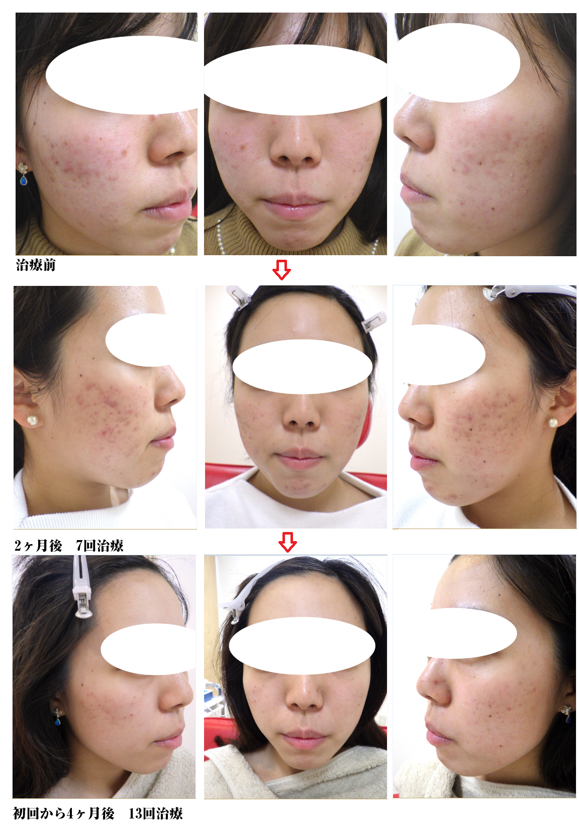 ニキビ治療症例写真 表参道美容皮膚科