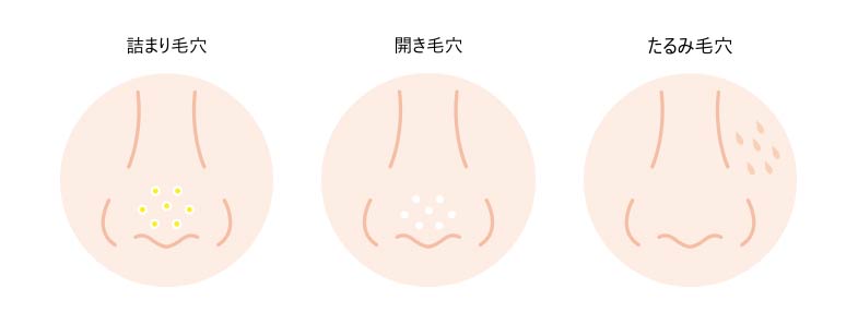 毛穴の種類とその原因